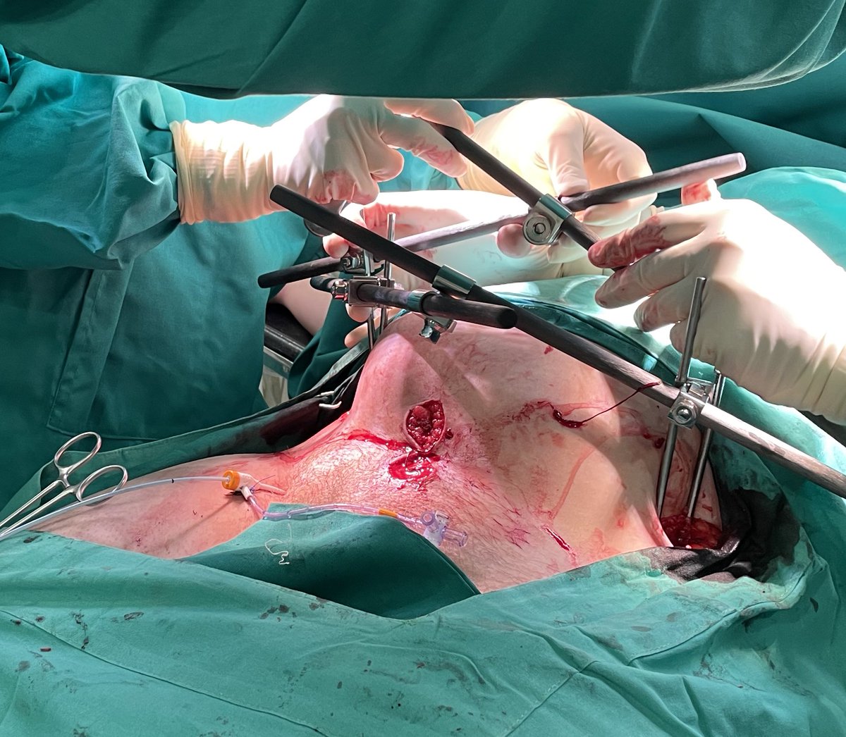 1. Fall from height 🚑
2. BP:70/40 ⚠️
3. Arterial access 4 fr💉
4. Massive TX.🩸
5. Image: Pelvis FX🦴
6. REBOA-zone1-3.🎈
7. PPP+Fix.🔧 <a href="/Asiritrauma1/">Mohammed Mar'ae Asiri🇸🇦</a> @traumakhan <a href="/TopKniFe_B/">Bellal Joseph</a> <a href="/NakulRaykar/">Nakul Raykar</a> @Cirbosque <a href="/traumaicurounds/">Dr. Dennis Yong Kim, MMEd</a> <a href="/talherer/">Tal Hörer</a> <a href="/EVTMSociety/">EndoVascular resuscitation and Trauma Management</a> @SOCICH_ <a href="/pferrada1/">Paula Ferrada MD FACS FCCM MAMSE</a> <a href="/CarlosYanezCiru/">Carlos Yanez MD, MSc, FACS</a>