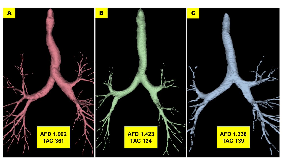 suryapbhatt's tweet photo. Our new manuscript is out. A high Airway Fractal Dimension may confer a reserve against the persistence of chronic bronchitis, regardless of changes in smoking status. https://t.co/i5YW98WqtL @sandeep_boddu @akizhakk @VictorKimMD @ThoraxBMJ @ATSCPAssembly @UABPulmonary https://t.co/FcHieJiBPX
