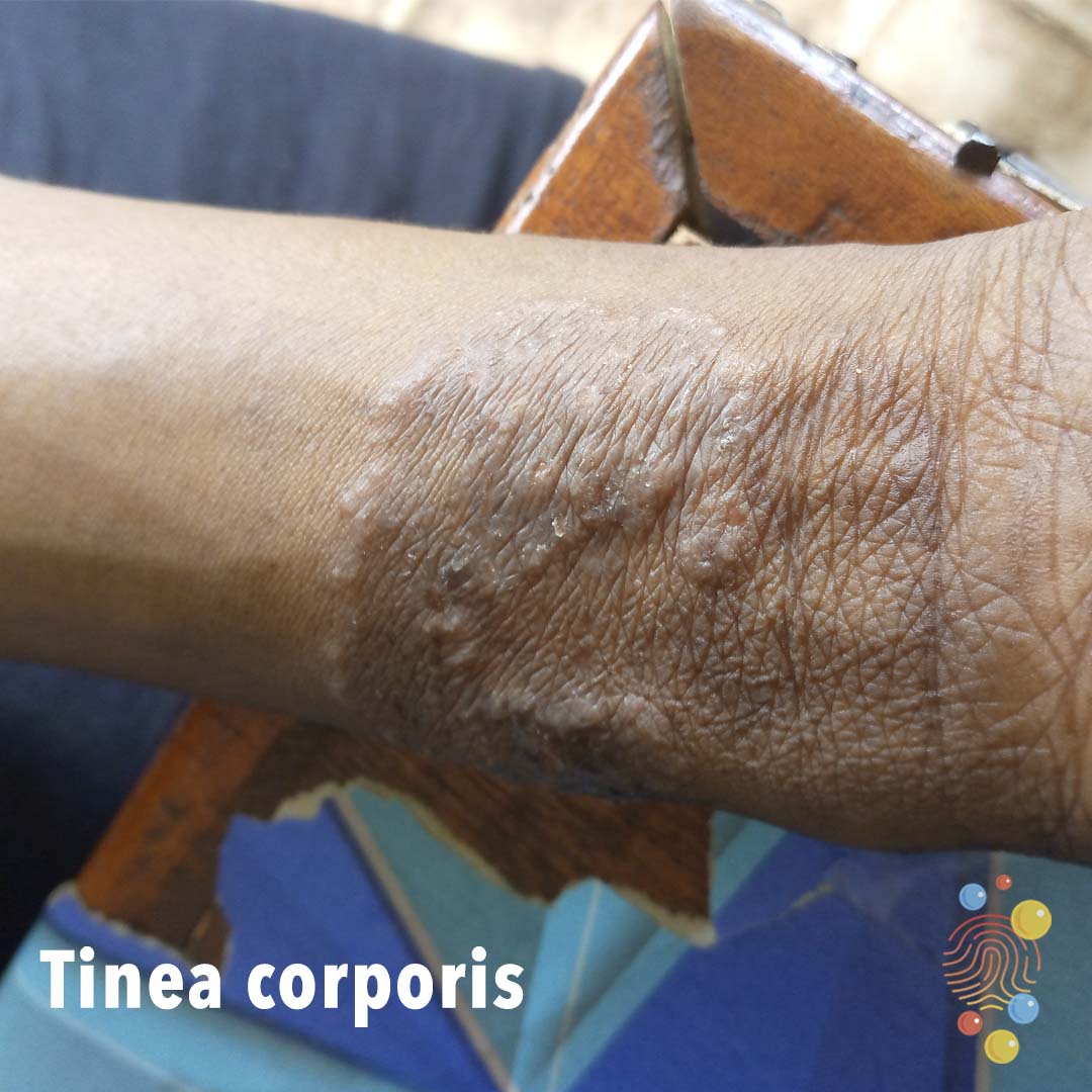 DFTBSkinDeep's tweet photo. 🧐The correct answer to the quiz was - Tinea corporis.

The image shows annular plaques plaques with some peripheral scaling on the limb.

Learn more 👉 https://t.co/XWiAqOK1x9

Here are more examples.
#skindeep #diversity #medtwitter #FOAMed https://t.co/wlWlpDSQgP