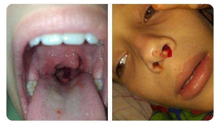 MarielenaQ7's tweet photo. Mi hermanito sigue necesitando con urgencia una cirugía de tumor, denominado angiofibroma juvenil estadio III. 

Dona 
Rt por favor 
Acá su campaña 👇
https://t.co/HDpxgtdx5J https://t.co/J2sLZPdU0R