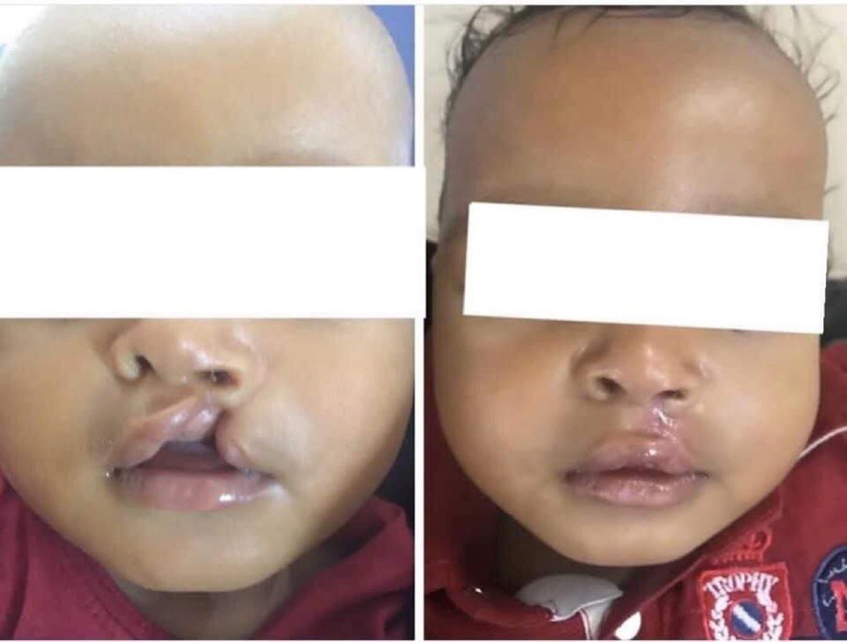 اول حاجه اعمل رتويت دي عمليات مجانيه 
وفرصه تساعد زول محتاج وتغير من حياه طفل عشان ترجع ليه الضحكه تاني بدون ما يكون معقد او عندو مشكله مواجهه المجتمع خلونا نرجع ليهم الامل تاني ..