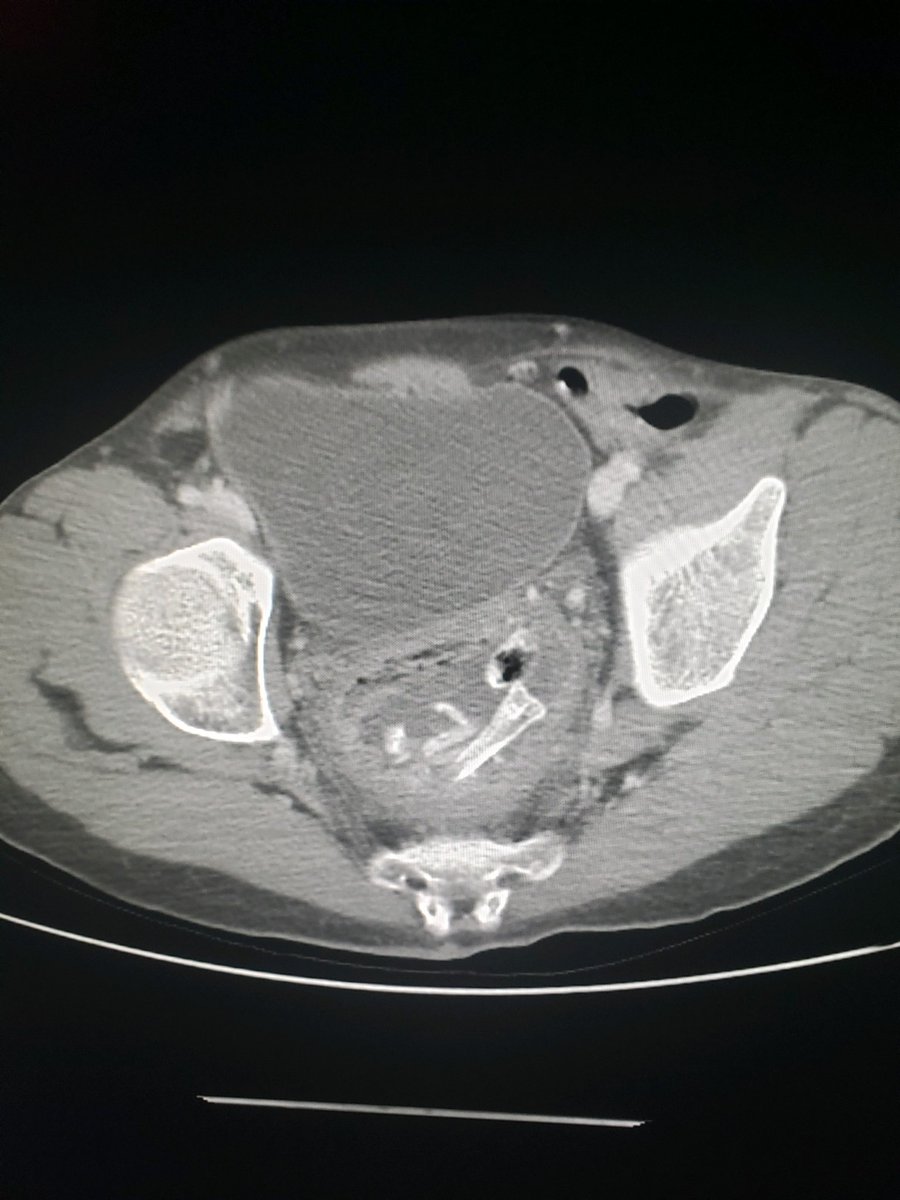 Today’s #foreignbodyfriday comes to us from St. Joe’s on the body service. Unfortunately CT is not good at determining if this person likes drumsticks or flats. But interesting to note that you can distinguish the cortex and medullary space of this chicken wing bone. 🐔 🍗🦴🍖