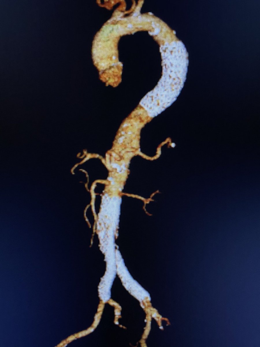 AortaSurg's tweet photo. TEVAR for symptomatic descending thoracic #aorta PAU in elderly with previous EVAR for #cvAAA https://t.co/eydATi9t9b