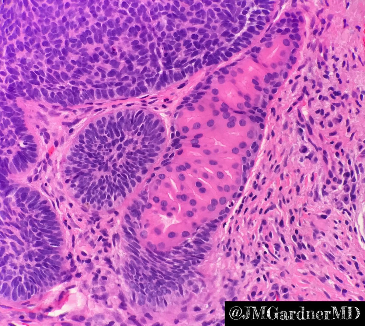 Apocrine differentiation in basal cell carcinoma. BCC can show adnexal features. If it looks like BCC overall, I call it BCC not adnexal tumor. See my BCC 101 video kikoxp.com/posts/3826 &amp; #dermpath survival guide bit.ly/2Te2haB #pathologists #pathology #pathTwitter