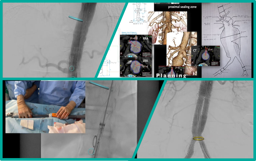 Vascupedia_com's tweet photo. #tipfortheweekend @ #Vascupedia
▶️ TAAA treatment with new precannulated off the shelf endograft | #technicalnote by Gioele Simonte 🇮🇹
https://t.co/DcvOttzqci
@AortaSurg @DrAliAzizzadeh @AWBeckMD @DrZeigler1 @Dr_Bowser @benstarnesmd @GustavoOderich
#aortaED #TAAA #aneurysm https://t.co/6TrdjWoaAL