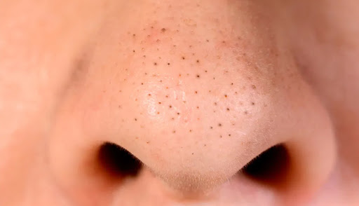 SkinOnlineBlog's tweet image. If you struggle with pimples or blackheads, beta hydroxy acid (BHA) may be your new best friend.Enter salicylic acid ow.ly/sZ6g30l5WpZ
#SkinOnline #SkinOnlineBlog #HydroxyAcids #BHA #AHA #SalicylicAcid #skin #pimples #beauty #skincare