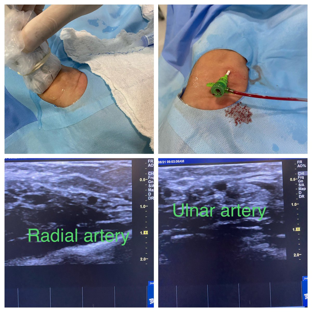 evandrofilhobr's tweet photo. Not rarely I see this doing all my access with US. An ulnar artery double size the radial and more superficial.
This time went for #ulnarfirst https://t.co/My4f81FYkY