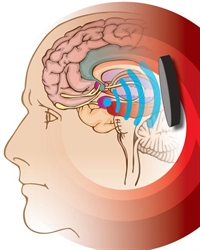 Brain stimulation without using electricity or a scalpel is one of the revolutionary features of ultrasound. It can help people with various brain disorders, such as epilepsy, anxiety disorder, depression and Parkinson's disease.

Find out more 👇
ru.nl/donders/news/n…