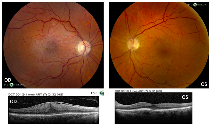 65 yo M w/ progressive blurry vision and metamorphosia. VA 20/60 OD, 20/50 OS, no improvement with pinhole. Imaging below. What’s the diagnosis? 

A. Retinal Detachment 
B. Macular hole
C. Epiretinal membrane
D. Parafoveal telangiectasia

Thanks <a href="/uiowaeye/">UIowa Eye</a> <a href="/EyeRounds/">EyeRounds</a>!