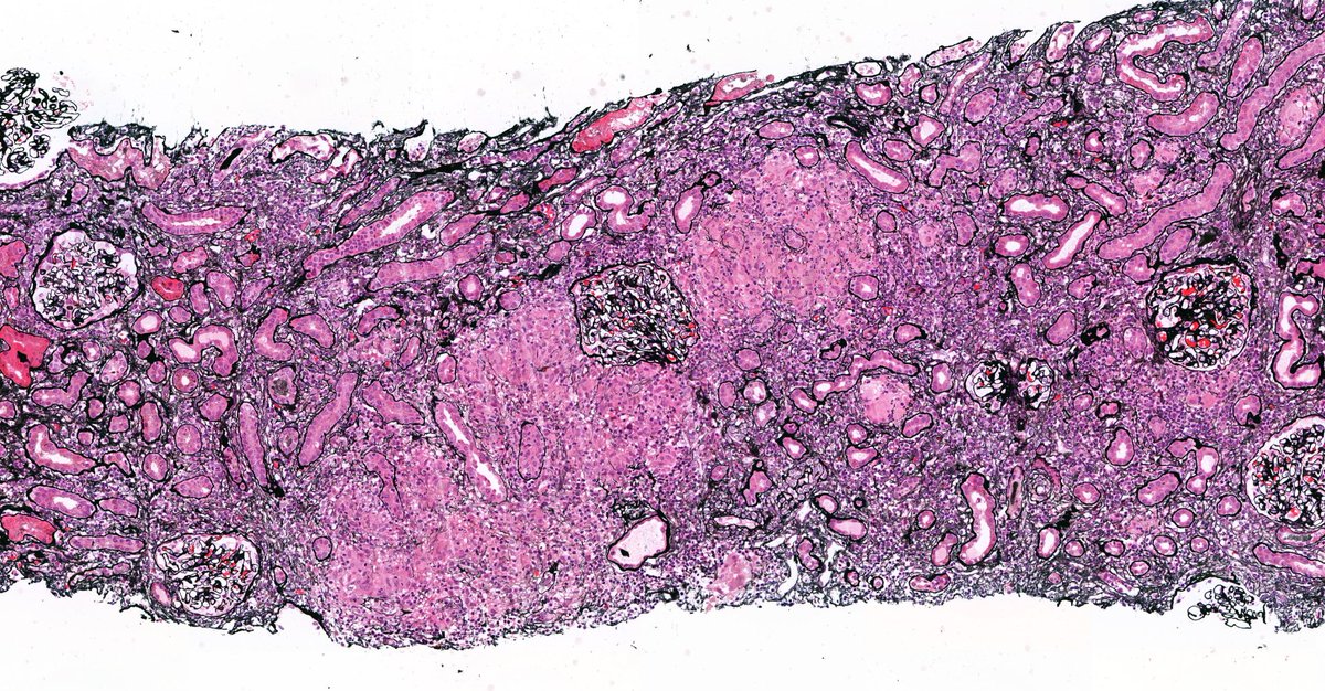 roboonya's tweet photo. Drug-induced granulomatous interstitial nephritis in 60 yo man who had history of NSAID use #renalpath https://t.co/EMMe2PMFUU