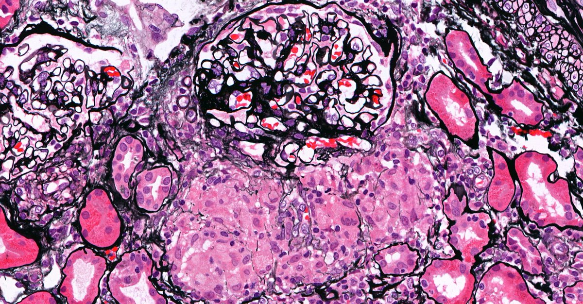 roboonya's tweet photo. Drug-induced granulomatous interstitial nephritis in 60 yo man who had history of NSAID use #renalpath https://t.co/EMMe2PMFUU