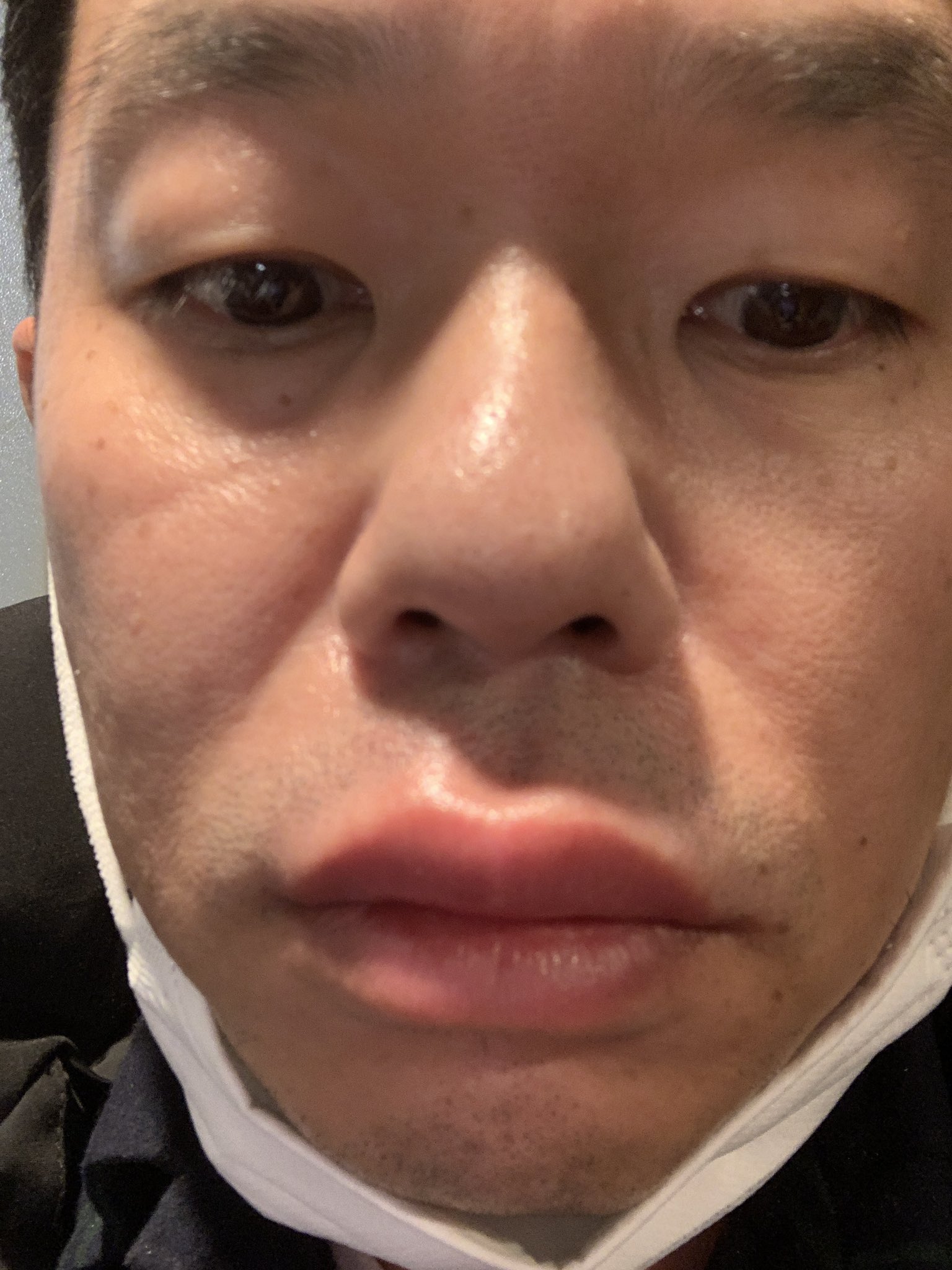 ダイアン津田 またこれや上唇腫れるやつ なんやねんこれ T Co Ysxqbkjx1x Twitter