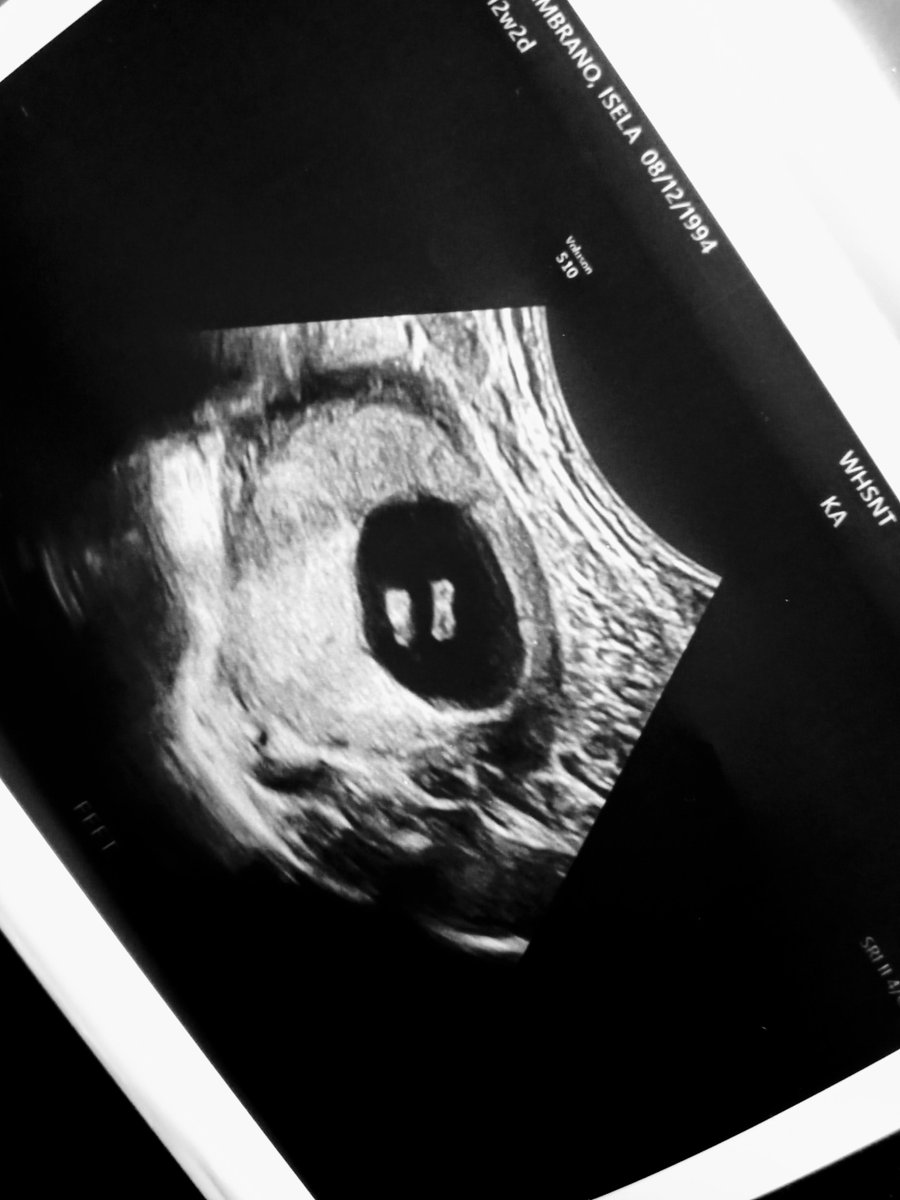 iselamarianaaa's tweet photo. We made a little runner!!👣❤😅 Making it twitter official for my 10 followers 😜 #Mommy2Be #LookAtOurPeanut 😭😍❤ https://t.co/mfJ09bLqJ8