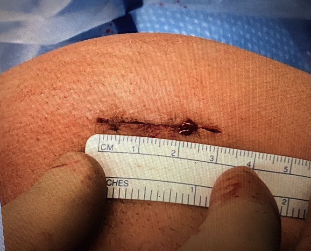 ACL Friday!! When harvesting an autograft tendon via a minimally invasive incision, using a small, curved needle (ie. a UR-6) can help w/defect closure. See an example technique here: arthroscopytechniques.org/article/S2212-… #ACLFriday #orthotwitter #MedTwitter #FOAMed @TSAOG_Ortho @BRIO_Research