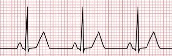 DanielUribeF's tweet photo. #RitmoSinusal.
Ritmo normal del corazón.
Inicia en el nodo sinusal.
Criterios: ondas P positivas de II, III y aVF, y de V2 a V6, negativas en aVR, isobifásica en V1; siempre seguidas de QRS; intervalo RR constante; intervalo PR ≥0.12"; frecuencia cardíaca normal de 60-100xmin. https://t.co/66jB83VJ0i