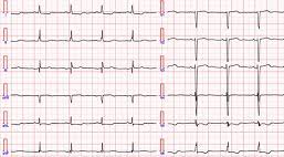 DanielUribeF's tweet photo. #RitmoSinusal.
Ritmo normal del corazón.
Inicia en el nodo sinusal.
Criterios: ondas P positivas de II, III y aVF, y de V2 a V6, negativas en aVR, isobifásica en V1; siempre seguidas de QRS; intervalo RR constante; intervalo PR ≥0.12"; frecuencia cardíaca normal de 60-100xmin. https://t.co/66jB83VJ0i