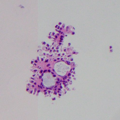 Sean McNair (@smcnair0328) on Twitter photo Fluids Friday @ my desk today! Here's a classic: Peritoneal Washing. Diagnosis: Serous Ovarian Borderline Tumor!
#PathTwitter #Cytology <a href="/CytoMermaid/">Taryn Waraksa-Deutsch, DHSc, SCT(ASCP), CMIAC</a> <a href="/Sara_Jiang/">Xiaoyin "Sara" Jiang, MD (She/Her)</a> <a href="/mtsiddi/">Momin Siddiqui</a> <a href="/sza_jhcyto/">Syed Z. Ali</a> <a href="/patwass/">Patricia Wasserman</a> <a href="/JS_Cytotech/">Jillian</a> @dannyjlubinpath Fluids Friday @ my desk today! Here's a classic: Peritoneal Washing. Diagnosis: Serous Ovarian Borderline Tumor!
#PathTwitter #Cytology <a href="/CytoMermaid/">Taryn Waraksa-Deutsch, DHSc, SCT(ASCP), CMIAC</a> <a href="/Sara_Jiang/">Xiaoyin "Sara" Jiang, MD (She/Her)</a> <a href="/mtsiddi/">Momin Siddiqui</a> <a href="/sza_jhcyto/">Syed Z. Ali</a> <a href="/patwass/">Patricia Wasserman</a> <a href="/JS_Cytotech/">Jillian</a> @dannyjlubinpath