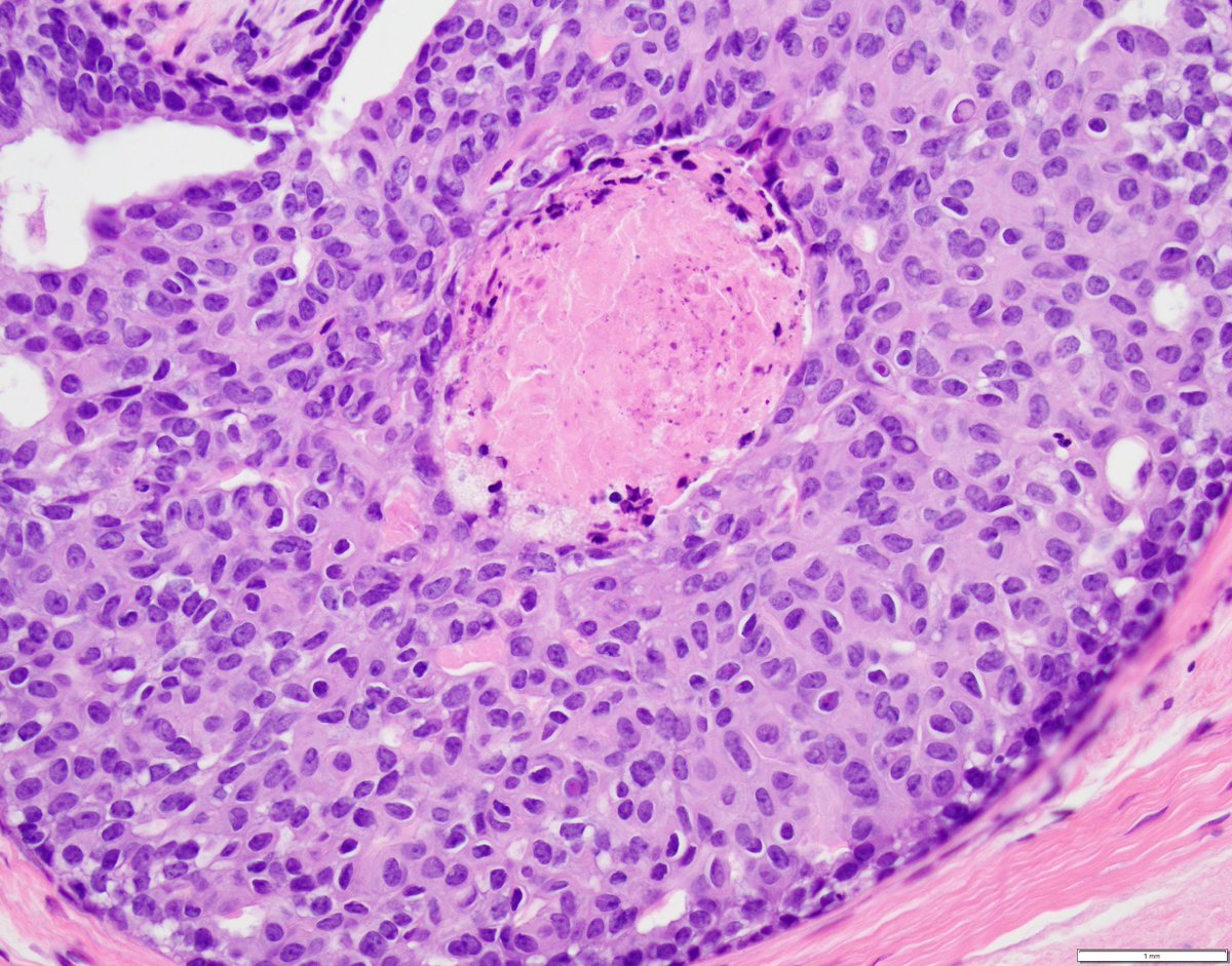 ISBP (@theisbp) on Twitter photo Happy New Year! 57 years old woman, lumpectomy with separate margins for DCIS. The lesion was found in one of the margin specimens. Diagnosis? <a href="/EdiBrogi/">Edi Brogi</a> @fcschmitt <a href="/drgfarshid/">Gelareh Farshid</a> <a href="/rovingatuscap/">Samson W. Fine, MD</a> <a href="/SchnittStuart/">Stuart Schnitt</a> <a href="/CollinsLauraC/">Laura Collins</a> <a href="/AGrabenstetter/">Anne Grabenstetter</a> <a href="/mkw_MD/">Melissa Krystel-Whittemore, MD</a> <a href="/LizaMQuintana/">Liza Quintana, MD</a> <a href="/HannahYWen/">Hannah Wen</a> Happy New Year! 57 years old woman, lumpectomy with separate margins for DCIS. The lesion was found in one of the margin specimens. Diagnosis? <a href="/EdiBrogi/">Edi Brogi</a> @fcschmitt <a href="/drgfarshid/">Gelareh Farshid</a> <a href="/rovingatuscap/">Samson W. Fine, MD</a> <a href="/SchnittStuart/">Stuart Schnitt</a> <a href="/CollinsLauraC/">Laura Collins</a> <a href="/AGrabenstetter/">Anne Grabenstetter</a> <a href="/mkw_MD/">Melissa Krystel-Whittemore, MD</a> <a href="/LizaMQuintana/">Liza Quintana, MD</a> <a href="/HannahYWen/">Hannah Wen</a>