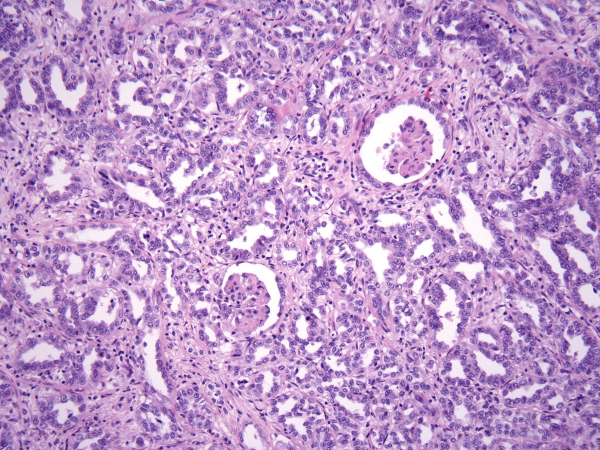 MichelleDunno17's tweet photo. Enjoy our review on 'medullary-based renal tumors'.🔬 @BWHPath @GU_Path_Society @ArchivesPath #gupath 

The Differential Diagnosis of Medullary-Based Renal Masses https://t.co/28pD7ZTHxM https://t.co/9o0qgfhuaT