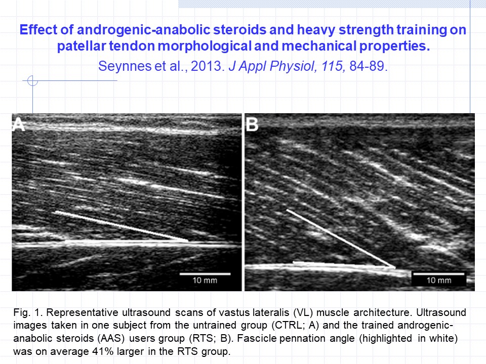 nm_mullins's tweet photo. Looking for cool stuff on #pennation for #kinesiology class. Found this. AAS use is not cool, but the article & ultrasound images are super cool.
Effect of #AndrogenicAnabolicSteroids & heavy #StrengthTraining on...
@APSPhysiology @nih_sognsvann
https://t.co/Khs51d8984 https://t.co/txIRxdrmKn