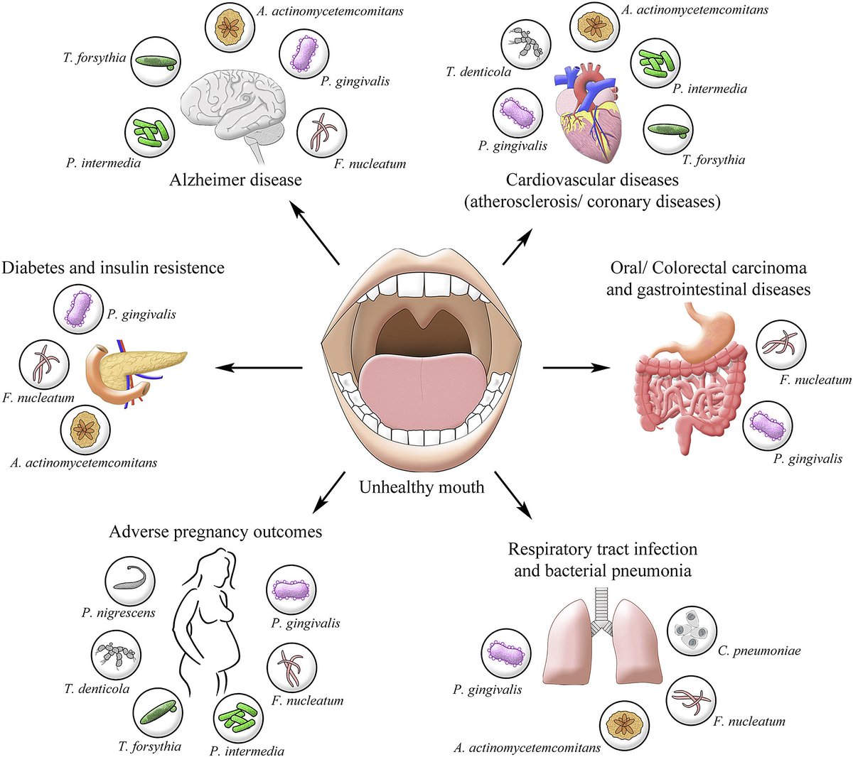 Association between periodontal pathogens and systemic disease

(free review article)

sciencedirect.com/science/articl… #openaccess #oralhealth #Dentist #dentalhealth