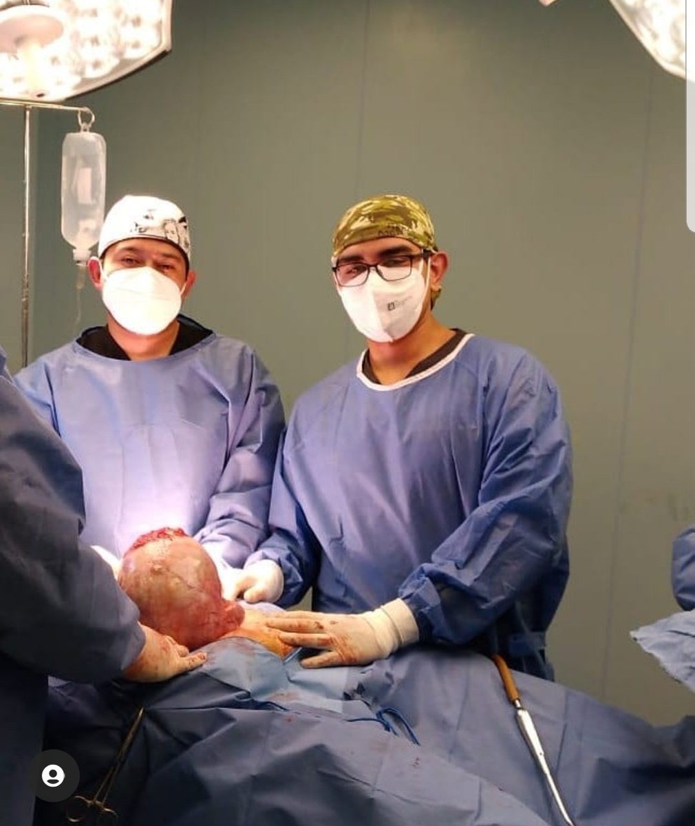 JuanDav61344652's tweet photo. Tumor de ovario gigante #oncocx https://t.co/BwDbDKhs3N