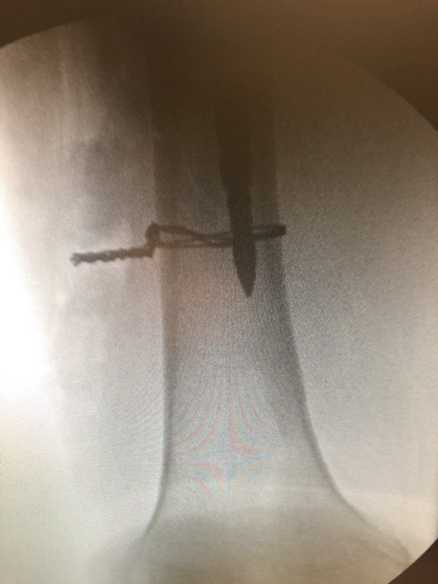 Distal fragments identified with <a href="/TotalHipKnee/">David A. Molho, M.D.</a> . Fx all the way to distal lateral metaphysis with comminution there. Canal re-established over a long reamer and wired anatomically.