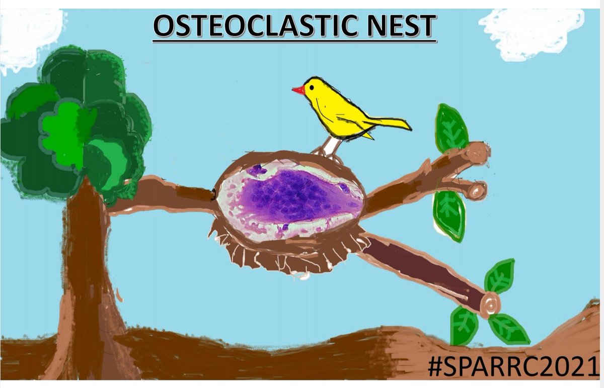 ChristinaGoveas's tweet photo. #pathtwitter #entryforsparrcography #giantcell #cytopath #sparrc2021 #osteoclasticgiantcell
@archibhat3 @Swathiprabhu5 @lovelygeorge10 @anjuthevirgo @pathridle_susan @lizaloren @Divya_Madhala @Meghna0630 @niki_2389 @TristanRutland7 @PaviSaaiarun @SPARRC21 https://t.co/zeTaY8Tom2