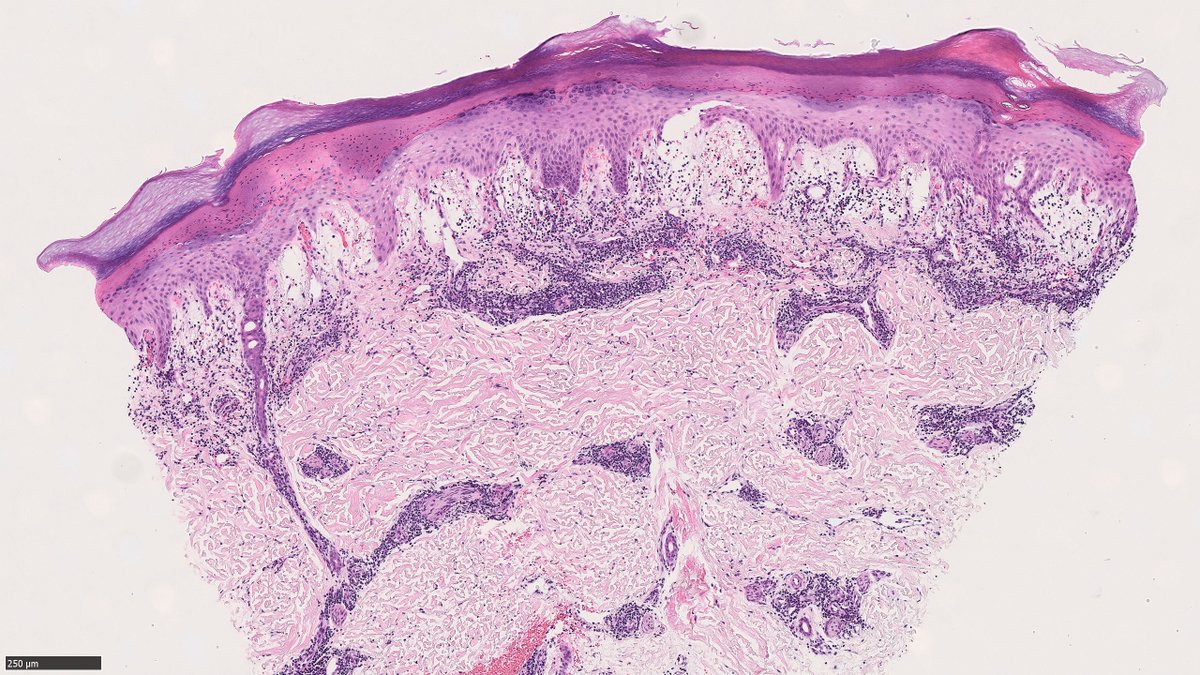 rayan_saade's tweet image. 18 yo F. L 2nd toe erythematous bumps and sores