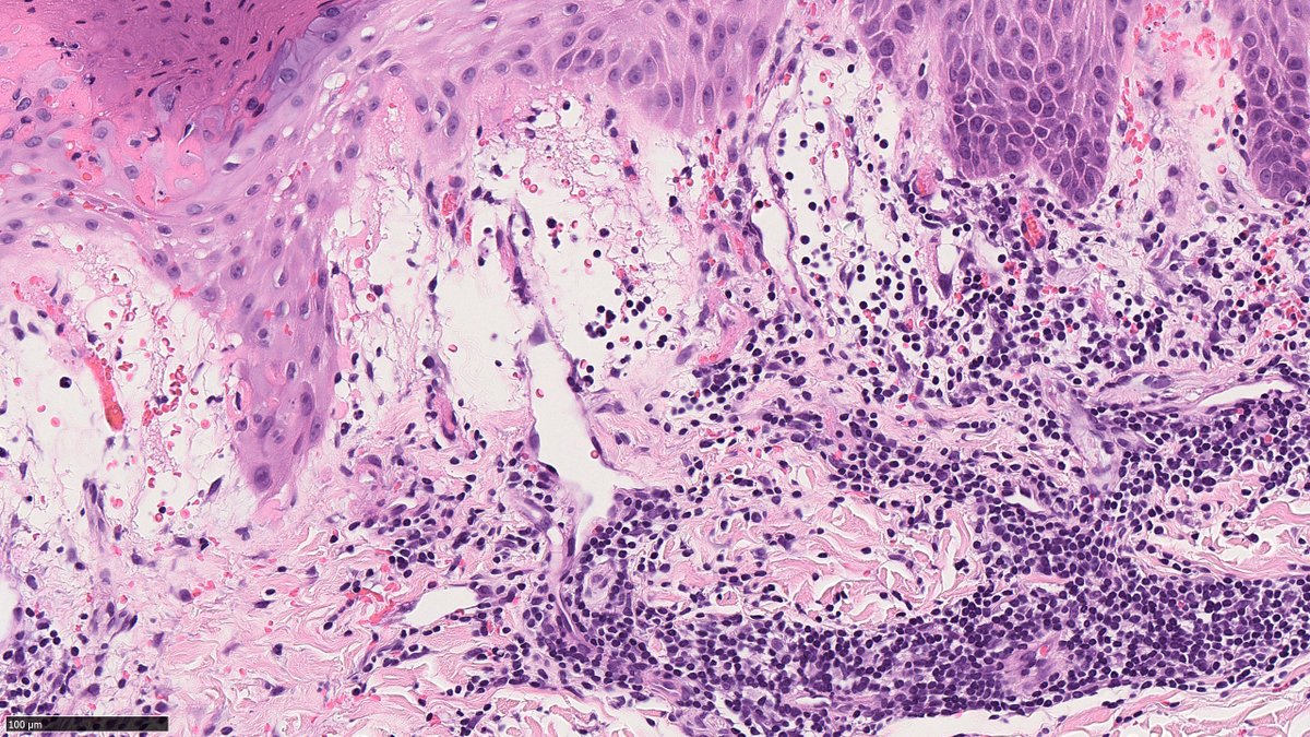 rayan_saade's tweet image. 18 yo F. L 2nd toe erythematous bumps and sores