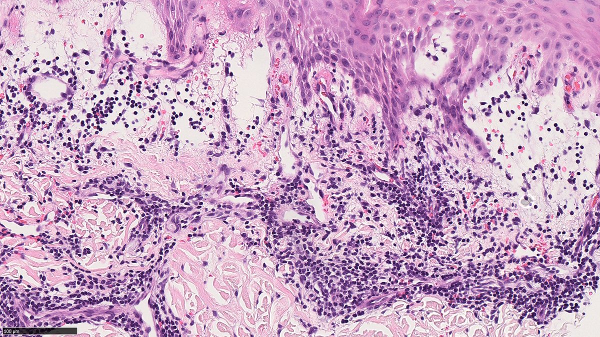 rayan_saade's tweet image. 18 yo F. L 2nd toe erythematous bumps and sores