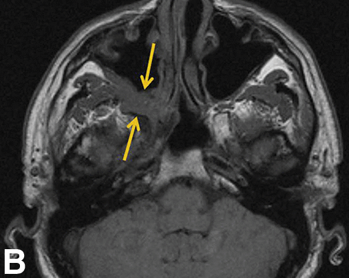 The pterygopalatine fossa is the key stop for perineural tumor spread coming along CN V2 branches from the orbit, sinonasal tract, and palate. Normal case vs. evil grey in the right PPF: