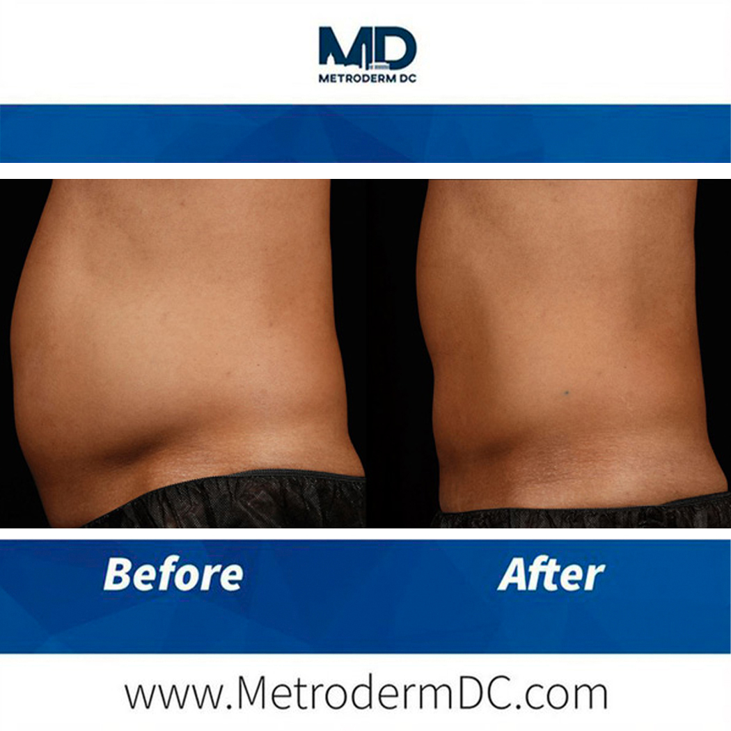 ToddEPerkinsMD's tweet photo. Before &amp; After: BODY CONTOURING  | https://t.co/H5ja3IOHh9 https://t.co/19jeleDBhs