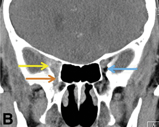 The orbital apex has fat. Tumor squeezing along cranial nerves through the superior and inferior orbital fissures and optic canal will blur this fat.Melanoma on the right vs. normal on the left: