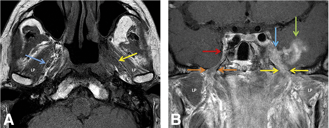 The trigeminal fat pad surrounds CN V3. Look for preservation of those straight lines in the medial masticator space between pterygoid muscles and venous plexusNormal right fat pad and nasopharyngeal cancer spreading via the left into foramen ovale and Meckel cave: