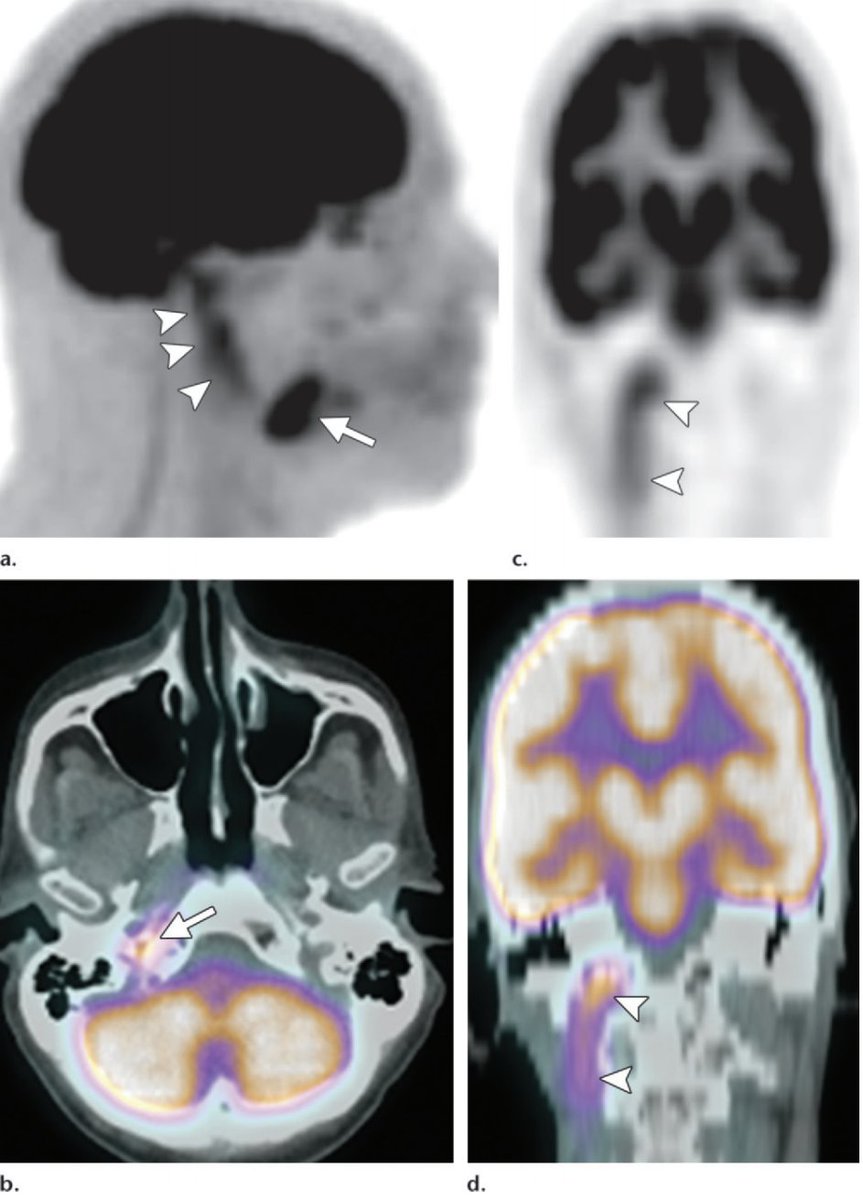 Tongue base cancer can spread along CN XII (hypoglossal) https://pubs.rsna.org/doi/pdf/10.1148/rg.336135501