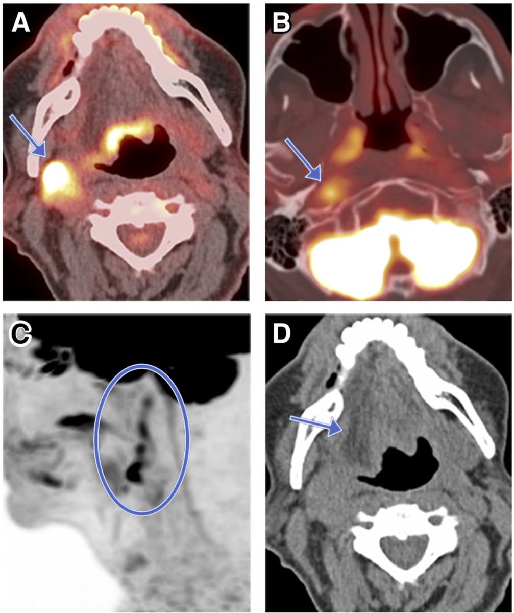 Hemitongue denervation changes (edema, enhancement, and/or fatty change, straight border down the midline) are an important clue to involvement of the hypoglossal nerve
