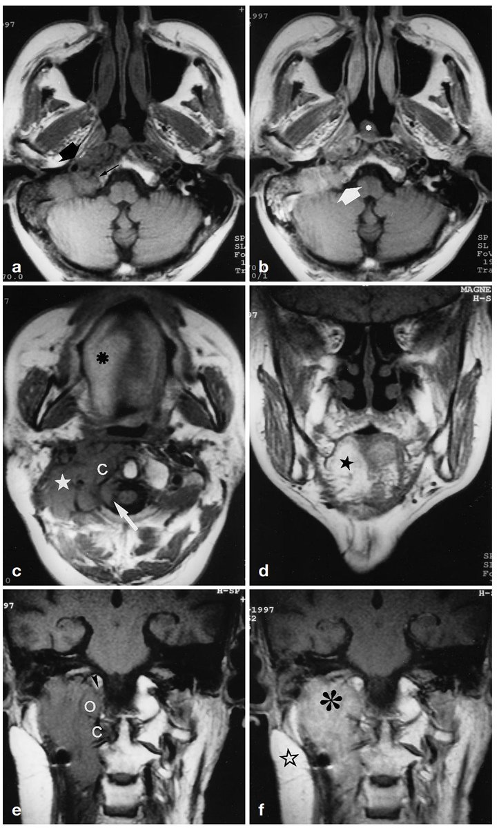 Nasopharyngeal carcinoma can directly extend to the skull base including the hypoglossal canal. These cases won't be subtle - you don't really need a fat pad to help you here.  http://doi.org/10.1007/s003300050492