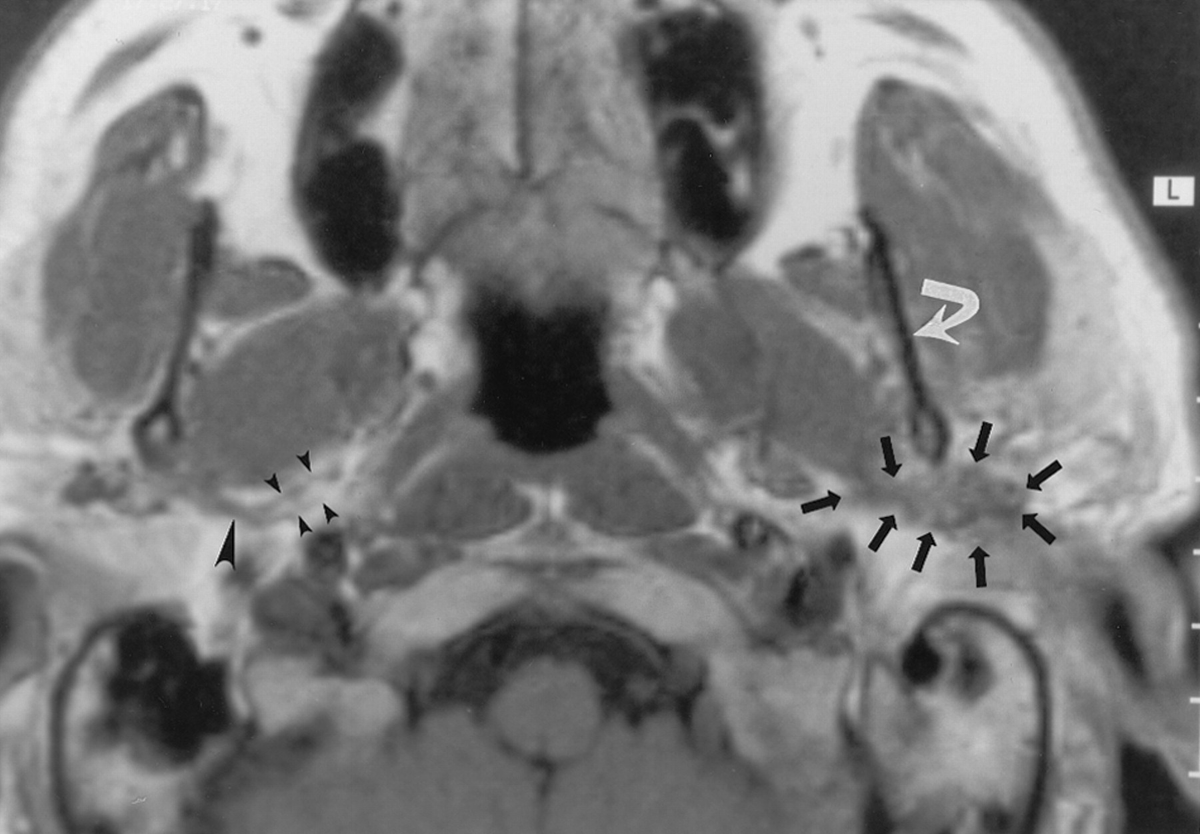 That's all folks.Actually, bonus fact:The auriculotemporal nerve is a potential connection between CN V3 and VII for perineural spread. Look just posterior to the mandible! http://ajnr.org/content/23/2/303Normal on the right vs. mucoepidermoid carcinoma from left parotid