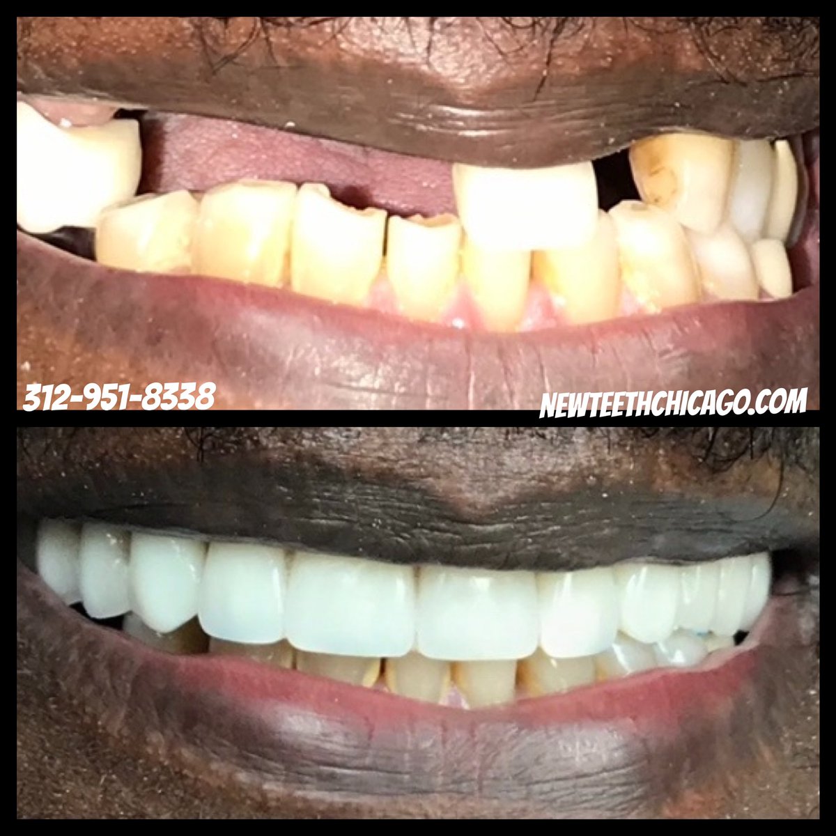 Newteethglobal's tweet photo. Want to see natural results like this will full jaw dental implants (Allon4) implants call 312-951-8338 for a consultation! This is a before and after of upper jaw case only! https://t.co/MPr2p6iltC