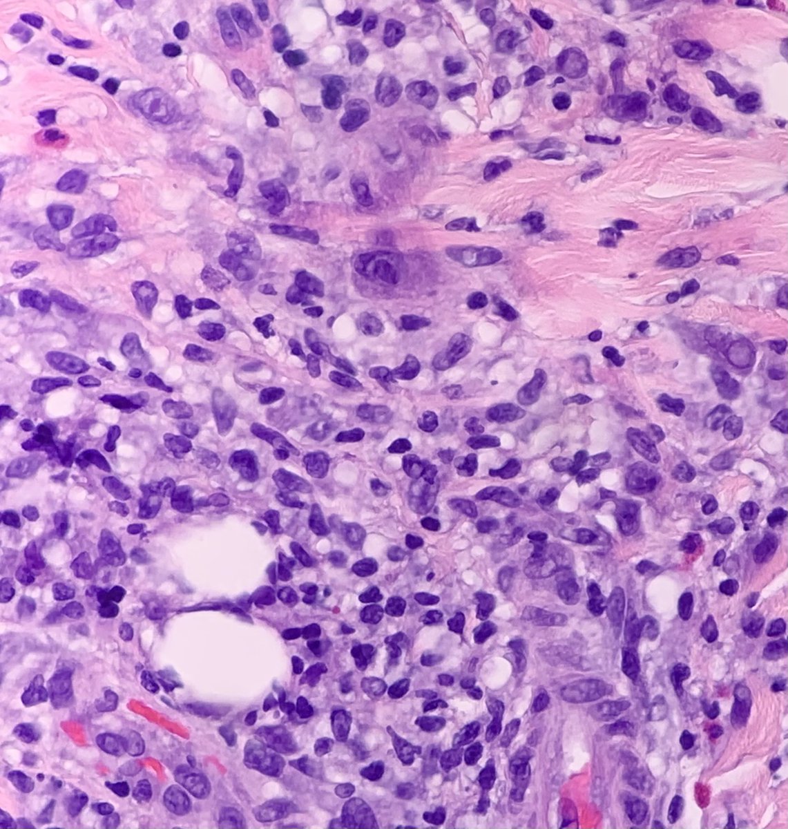 JakkiPath's tweet photo. Atypical dermal lymphocytes...but close inspection of the epidermis reveals the diagnosis. 
Don’t forget about scabies simulating atypical lymphoproliferative disorders! #dermpath https://t.co/I3kQ5W0kKs