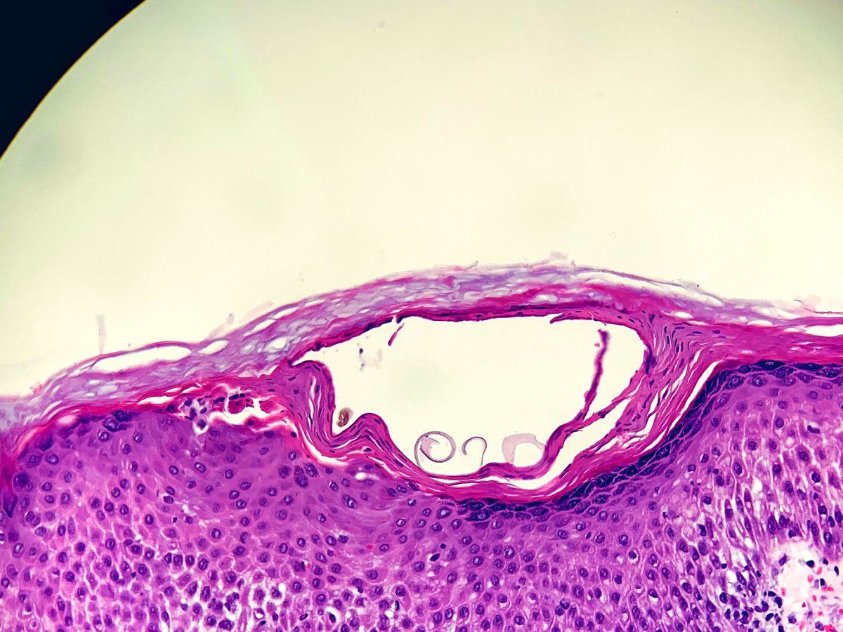 Atypical dermal lymphocytes...but close inspection of the epidermis reveals the diagnosis. 
Don’t forget about scabies simulating atypical lymphoproliferative disorders! #dermpath