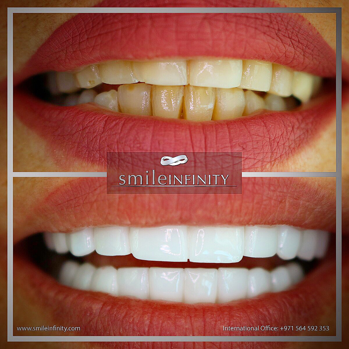 habibzarifeh's tweet photo. #Lebanon #dentist #smile #beirut #smileinfinity #veneers #hollywoodsmile #dubai https://t.co/cjUXxfrecW