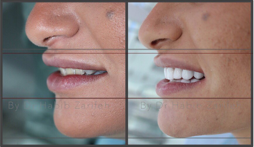 habibzarifeh's tweet photo. #Lebanon #dentist #smile #beirut #smileinfinity #veneers #hollywoodsmile #dubai https://t.co/cjUXxfrecW
