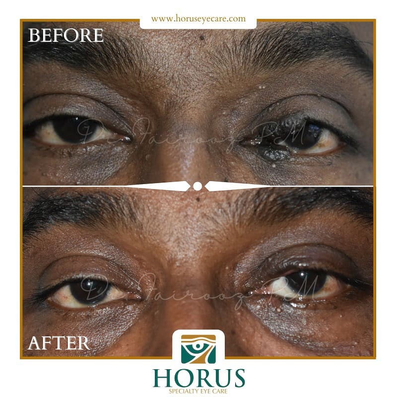 CancerEye's tweet photo. A 𝗞𝗶𝘀𝘀𝗶𝗻𝗴 𝗡𝗲𝘃𝘂𝘀 is a type of darkly pigmented lesion involving equal portions of the upper and lower eyelid, and it extends to the lid margins- kissing each other :-)

Read more:

https://t.co/xGeuXqoLu0 https://t.co/n9TYy1NLuw