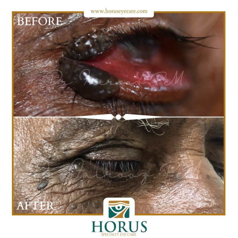 CancerEye's tweet photo. A 𝗞𝗶𝘀𝘀𝗶𝗻𝗴 𝗡𝗲𝘃𝘂𝘀 is a type of darkly pigmented lesion involving equal portions of the upper and lower eyelid, and it extends to the lid margins- kissing each other :-)

Read more:

https://t.co/xGeuXqoLu0 https://t.co/n9TYy1NLuw
