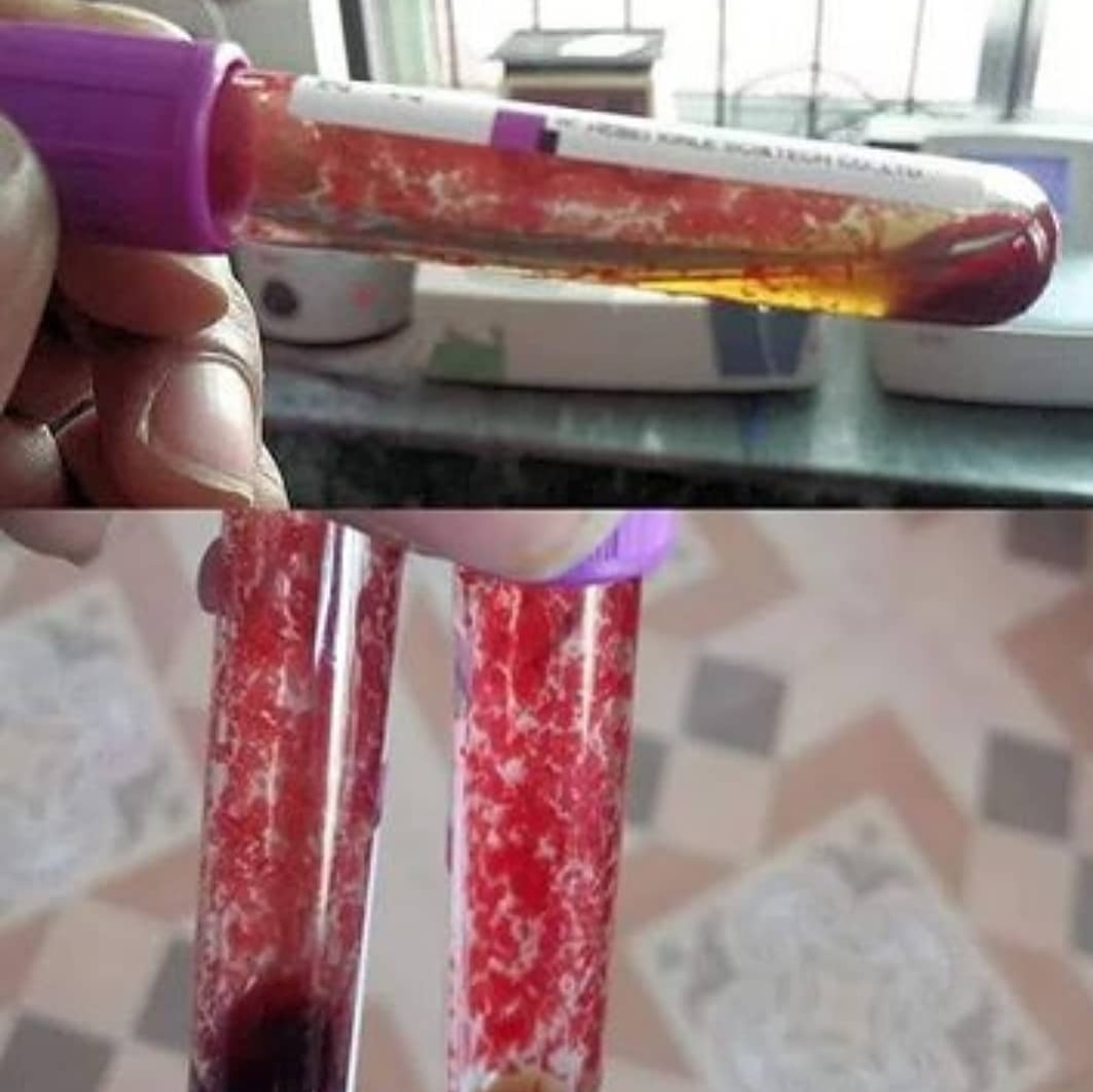 mICROBIOsh's tweet photo. La enfermedad por crioaglutininas es un tipo raro de anemia hemolítica autoinmune el sistema inmunitario ataca y destruye por error sus propias células rojas de la sangre (globulos rojos). https://t.co/utVjO5hGyd