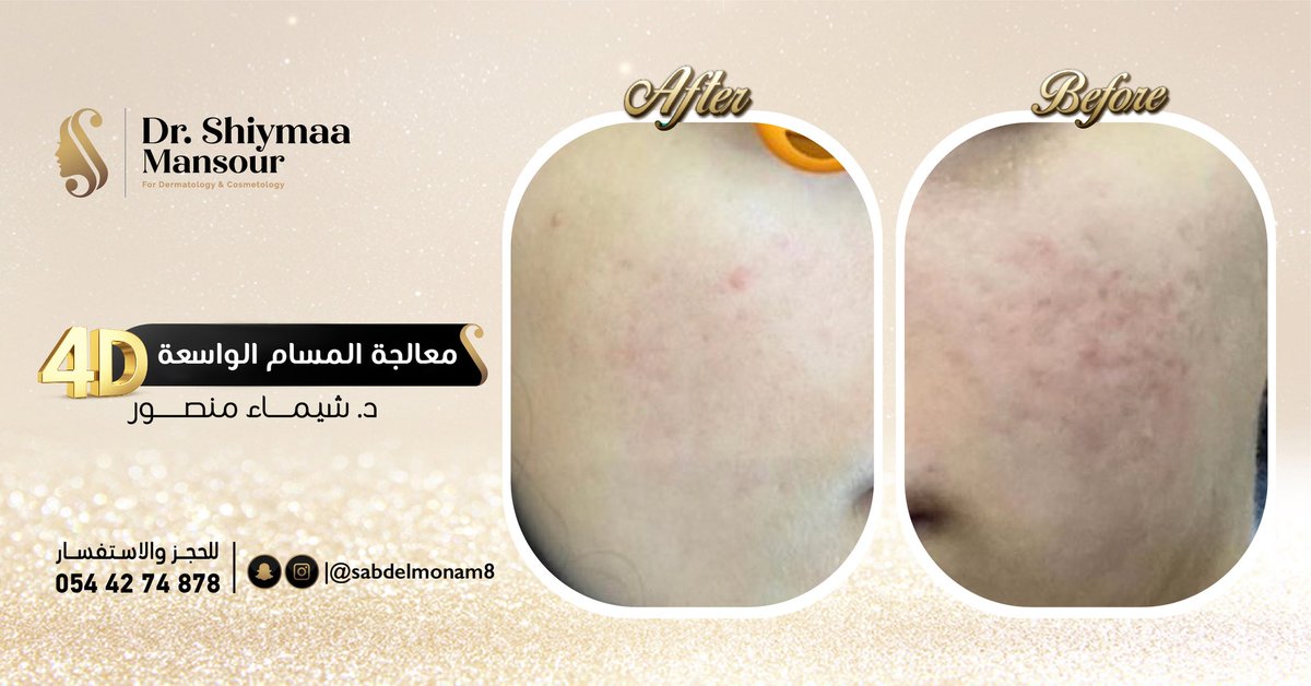 DrShiymaa's tweet photo. حالات قبل و بعد مع الدكتورة شيماء منصور ( بعض المعالجات لجهاز #الفراكشنال
للحجز : اضغطي الرابط بالبايو ☝
الاتصال على : 0544274878
@oliviamedical
#4dface 
#تجميل #تجميل_الانف #فيلر #بوتكس
 #دكتورة_شيماء_منصور  #جده #عيادات_تجميل
#كنتور_الوجه 
#فراكشنال_ليزر_co2  #فراكشنال_ليزر https://t.co/IErUVPjROF