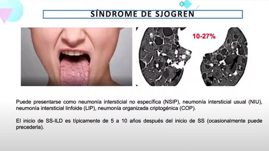 GEAS_SEMI's tweet photo. @MaykaFreire @PFanlo @fjrascon @GeasNavarra @GeasMadrid @joraltron @cpsimeon @JJRiosBlanco @bcgraciatello 🩺⚠️#Neumopatía #intersticial en el #síndrome de #Sjögren (#SS). 🫁
Factores de riesgo: sexo masculino, tabaquismo, SS primario, #Ro52, linfocitos >15% en el BAL
Más info en: GEAS-SS SEMI Registry
#registrosGEAS #registroSjögrenGEAS
https://t.co/cJ9cOnL0T1 https://t.co/dUf1n2Hxur https://t.co/5gWMJVBair