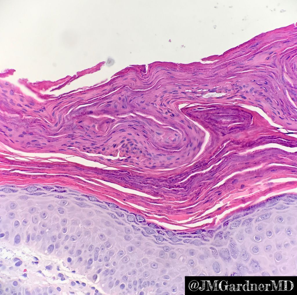 JMGardnerMD's tweet photo. Erythematous plaques in axilla/folds. Classic example...Your diagnosis? Also, name the polarizable bonus finding. Answers: https://t.co/gyK9NWzvmQ. Video: https://t.co/0L798WEysi. #Pathology #dermpath #dermatology #dermatologia #dermtwitter #pathologists #pathTwitter https://t.co/W9zySk7kjQ